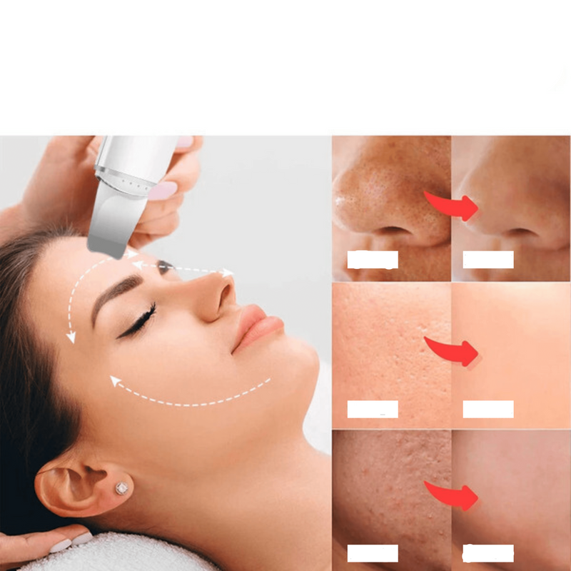 Esfoliador Ultrassônico de Pele: Removedor de Cravos e Limpador Facial com Cavitação - Neonex Store